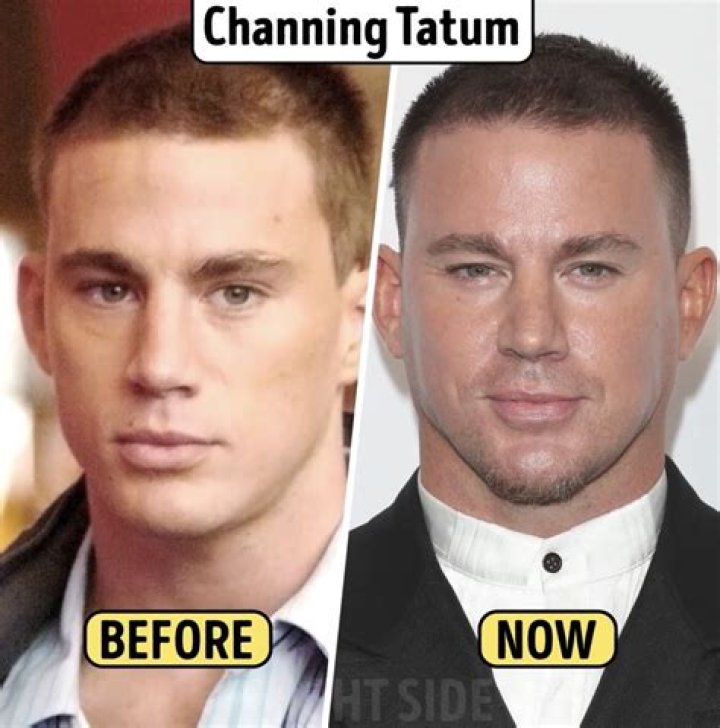 Channing Tatum Plastic Surgery Before and After