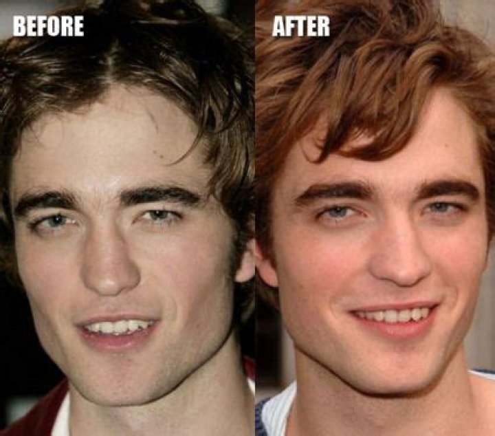 Robert Pattinson Plastic Surgery Before And After